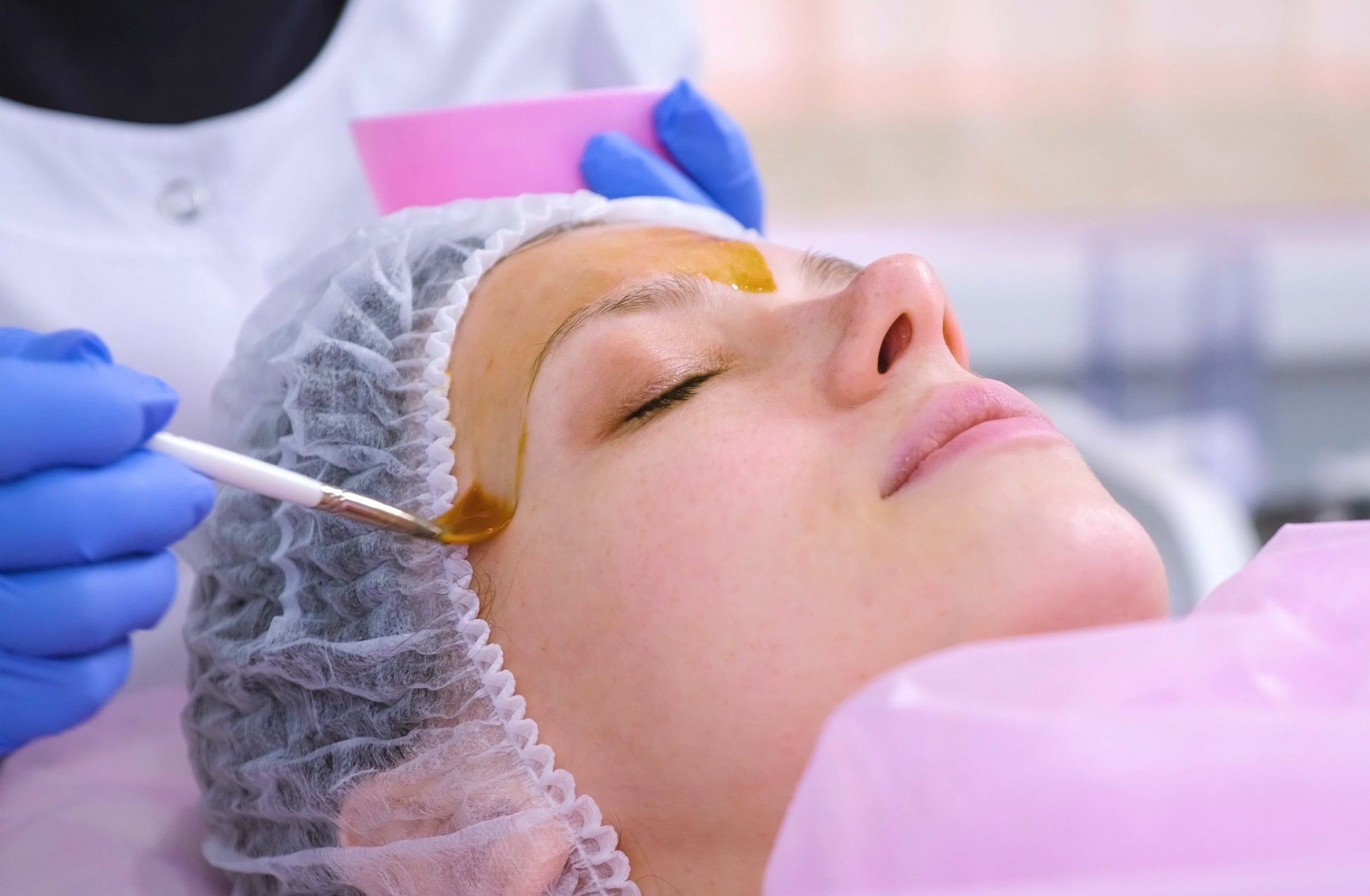 A Female getting chemical peels on her face | Aesthetic Artistry in Botox Burke, VA