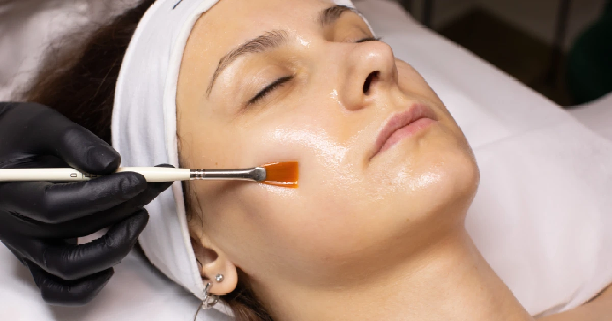A woman receiving Chemical Peels In Burke, VA