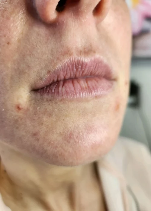 Botox at Aesthetic Artistry in Burke, VA