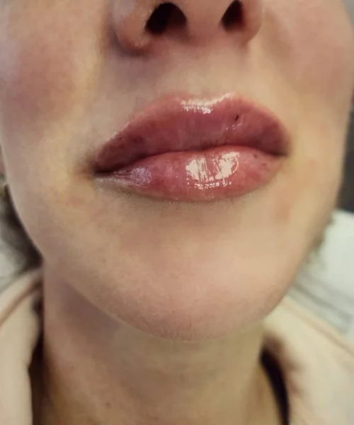 Lip Flip treatment in Burke, VA at Aesthetic Artistry