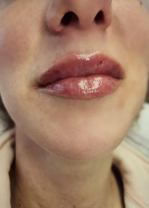 Lip Flip treatment in Burke, VA at Aesthetic Artistry