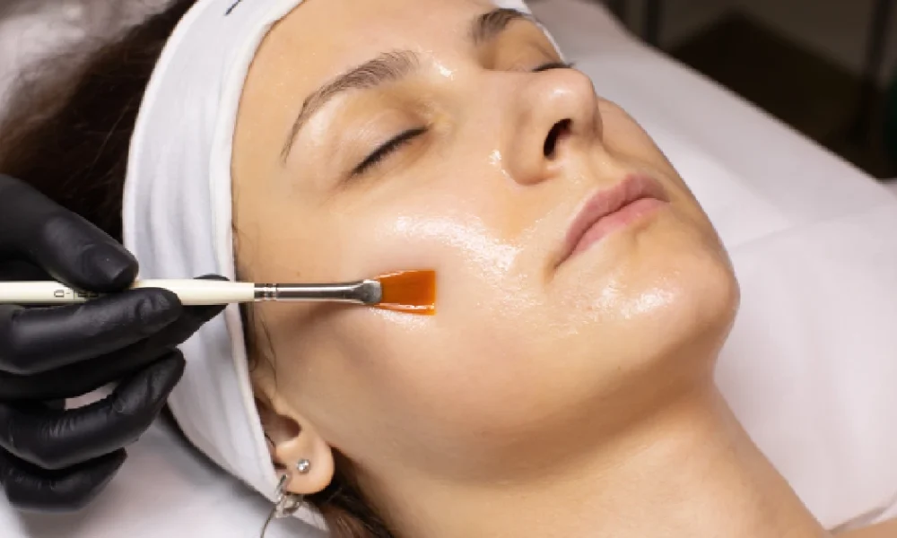 A woman receiving Chemical Peels In Burke, VA