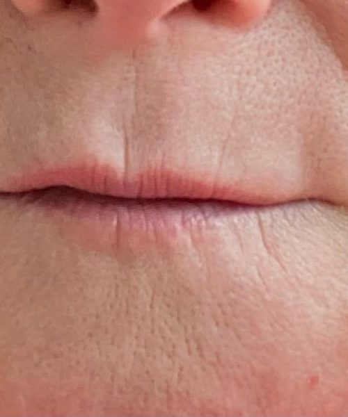 Lip Filler Before Treatment Photo | Aesthetic Artistry in Burke, VA