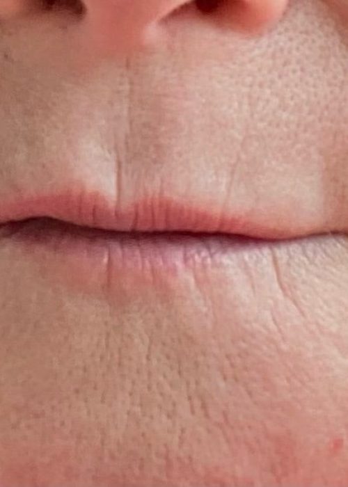 Lip Filler Before Treatment Photo | Aesthetic Artistry in Burke, VA