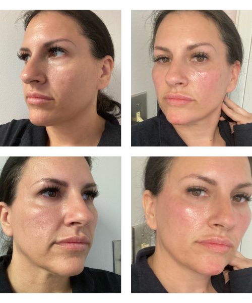 Female Filler Before and After Treatment Photo | Aesthetic Artistry in Burke, VA