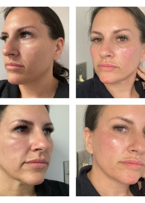 Female Filler Before and After Treatment Photo | Aesthetic Artistry in Burke, VA