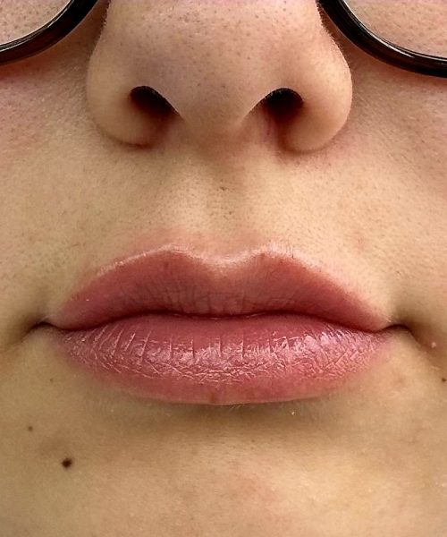 Lip Flip After Treatment Photo | Aesthetic Artistry in Burke, VA