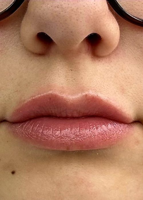 Lip Flip After Treatment Photo | Aesthetic Artistry in Burke, VA