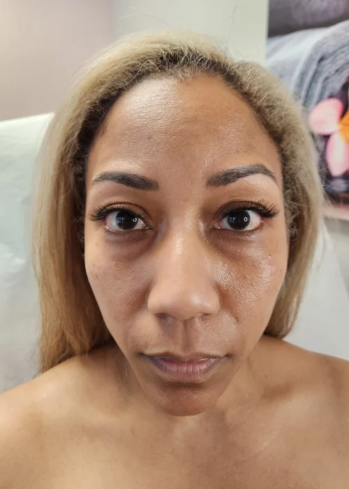 Before Tear Trough and Cheek Filler | Aesthetic Artistry in Burke, VA