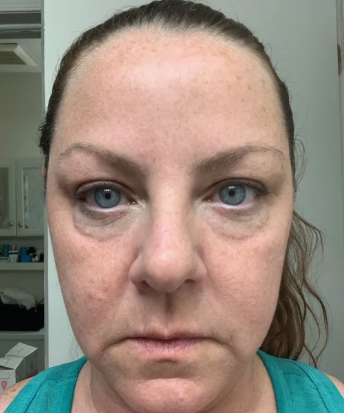 Before Tear Trough and Cheek Filler | Aesthetic Artistry in Burke, VA