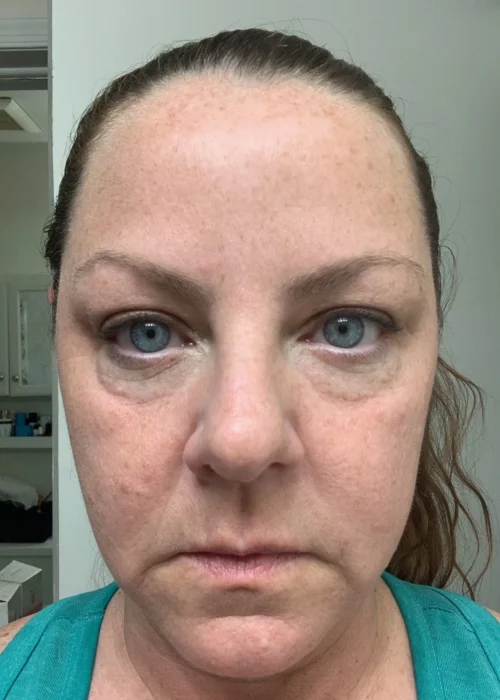 Before Tear Trough and Cheek Filler | Aesthetic Artistry in Burke, VA