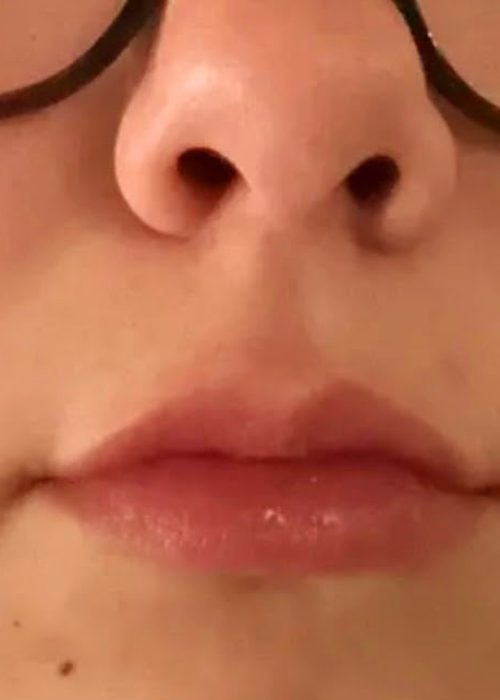 Lip Flip Before Treatment Photo | Aesthetic Artistry in Burke, VA