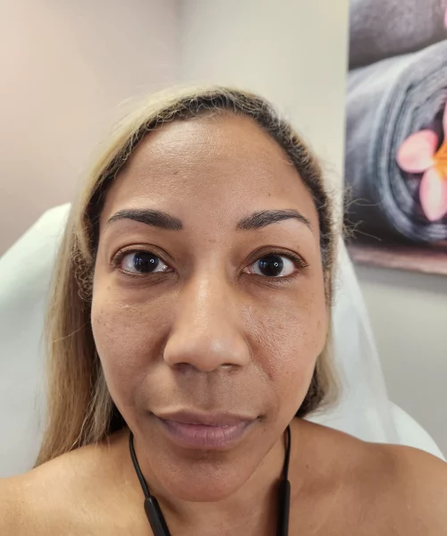 After Tear Trough and Cheek Filler | Aesthetic Artistry in Burke, VA