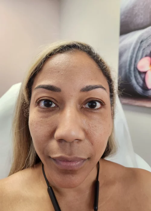 After Tear Trough and Cheek Filler | Aesthetic Artistry in Burke, VA