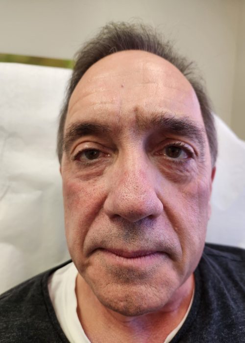 Male Cheek Filler and Trough Before Treatment Photo | Aesthetic Artistry in Burke, VA