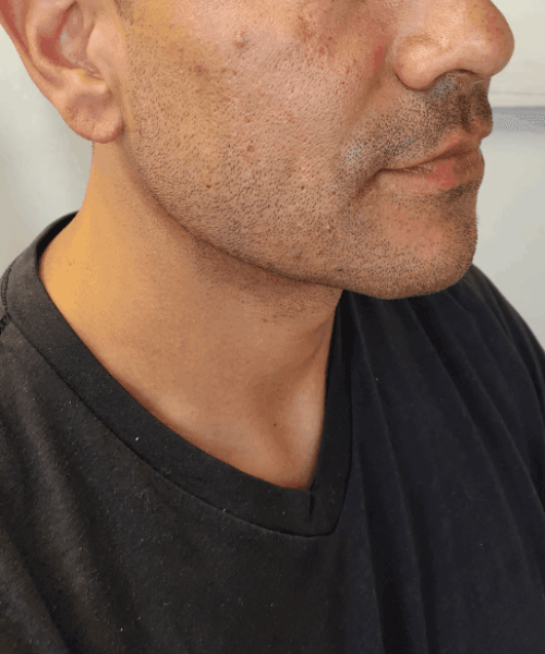 Using Cheek, Chin, Jawline Fillers After Image | Aesthetic Artistry in Burke, VA