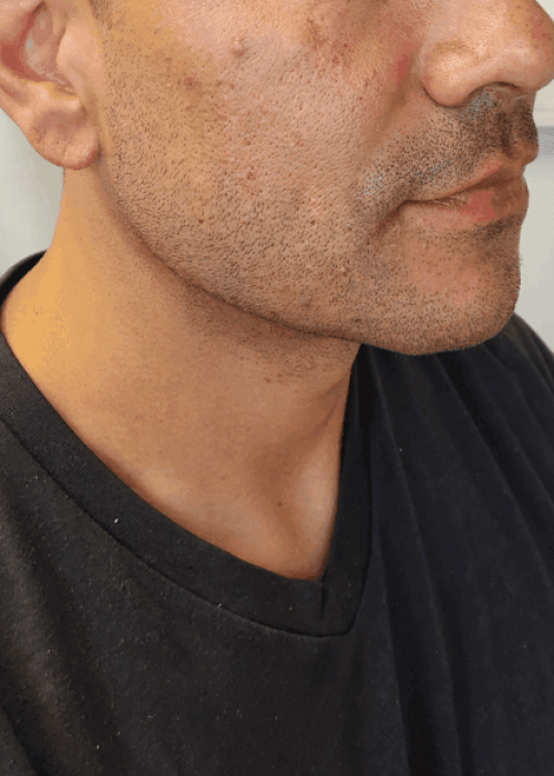 Using Cheek, Chin, Jawline Fillers After Image | Aesthetic Artistry in Burke, VA