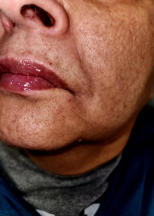 Lips Flip in Burke, VA at Aesthetics Artistry