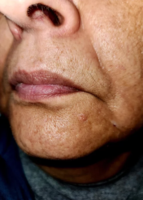 Lip Flip treatment before in Burke, VA at Aesthetic Artistry